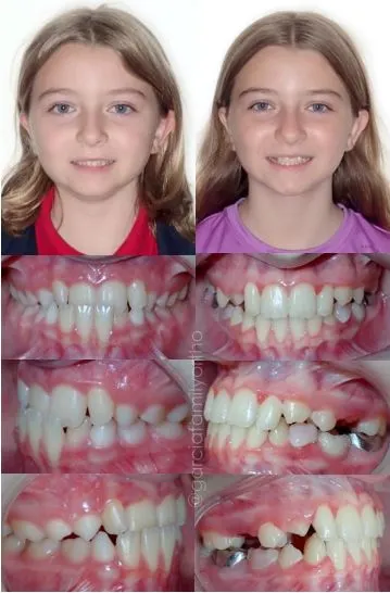 Antes y después de ortodoncia parcial