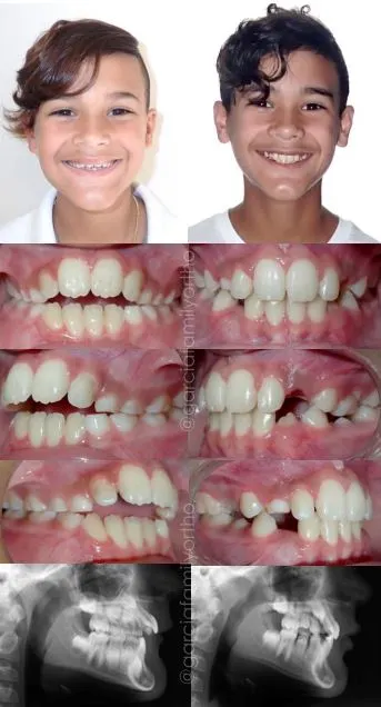 Antes y después de ortodoncia parcial