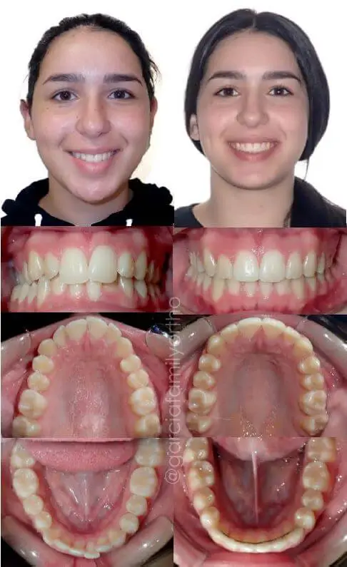 Before and After full braces