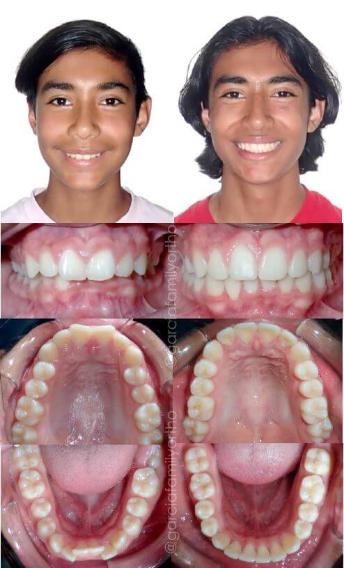 Before and After braces