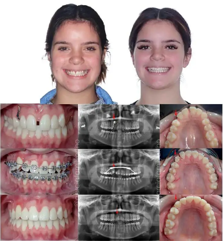 Before and After expander, full braces, and surgery