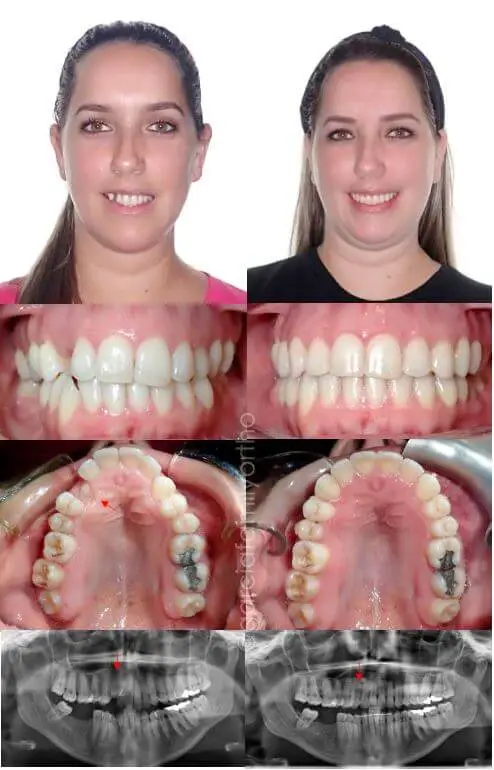 Before and After full braces