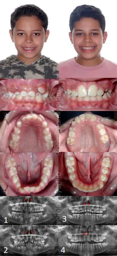 Antes y después de ortodoncia parcial y cirugía
