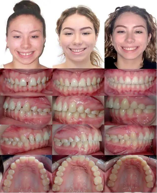 Before and After braces and build up restorations
