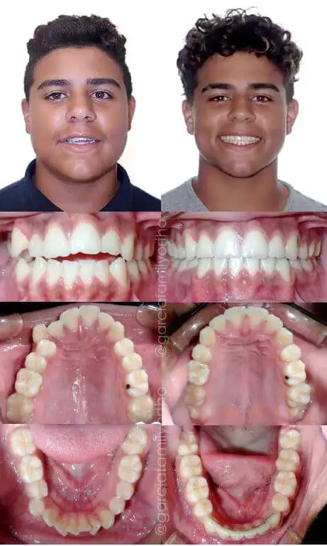 Antes y después de ortodoncia y extracciones